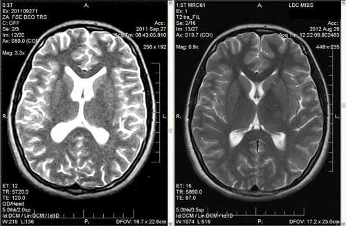 МРТ Снимок головного мозга